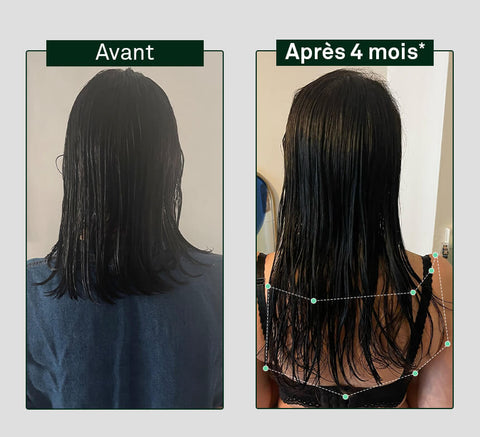 Pirms un pēc matu augšanas salīdzinājums uz cilvēka galvas, parādot redzamu atšķirību pēc 4 mēnešiem.
