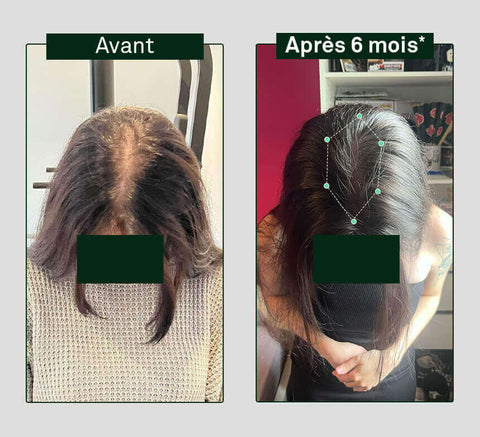 Hair Density Growth and Strengthening (3 months)